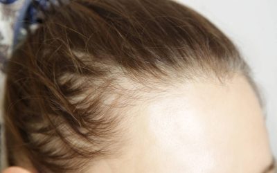 Pierdere Păr: Injecțiile de Slăbit Cauzează Alopecie