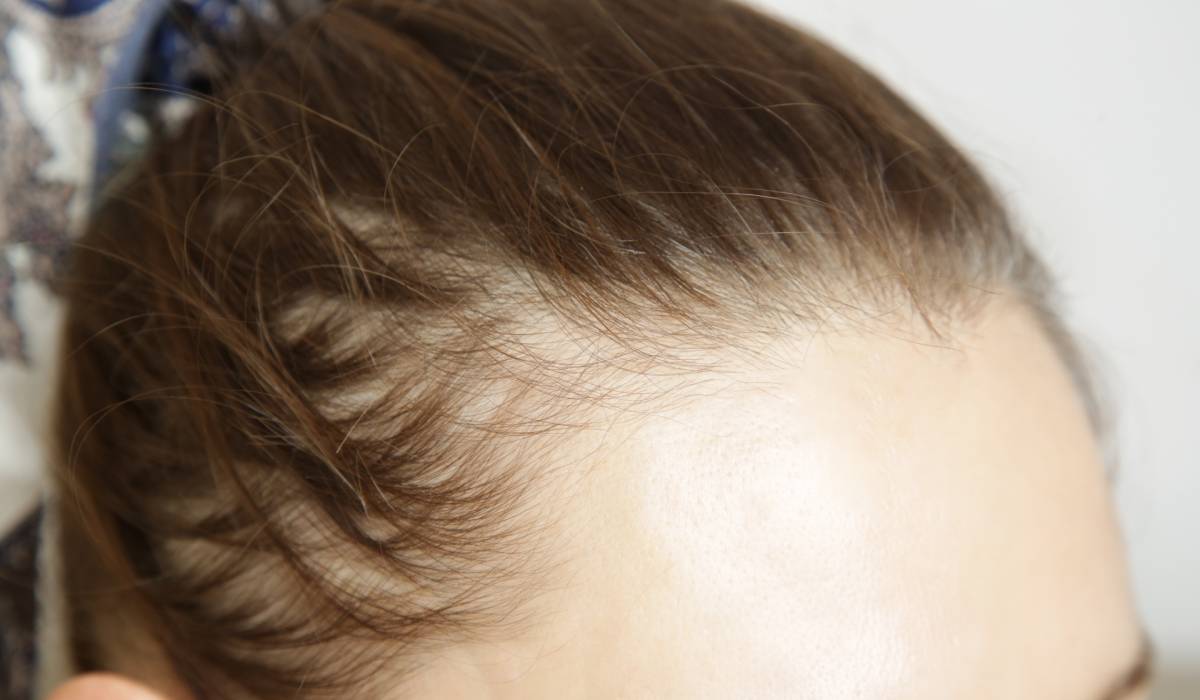 Pierdere Păr: Injecțiile de Slăbit Cauzează Alopecie