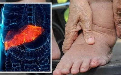 Picioarele anunță ficat gras. Gastroenterolog: „Nu ignorați!”