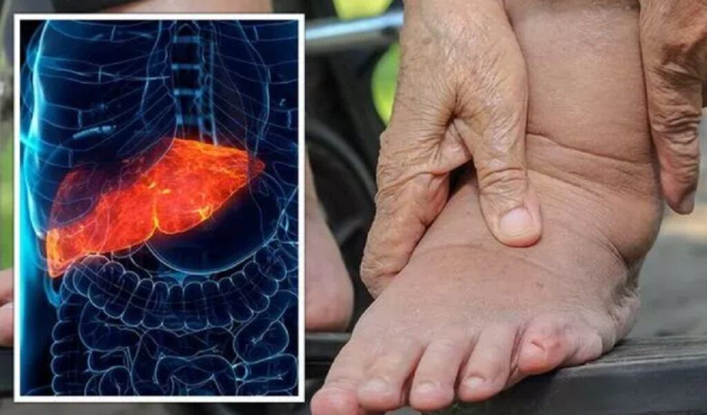 Picioarele anunță ficat gras. Gastroenterolog: „Nu ignorați!”
