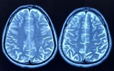 Depresia distruge creierul: Neuroni noi, în pericol