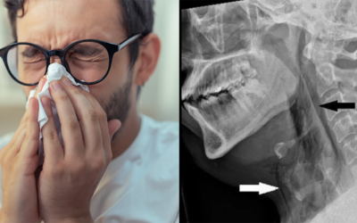Strănut reținut i-a rupt traheea. Gest banal periculos, avertizează medicii