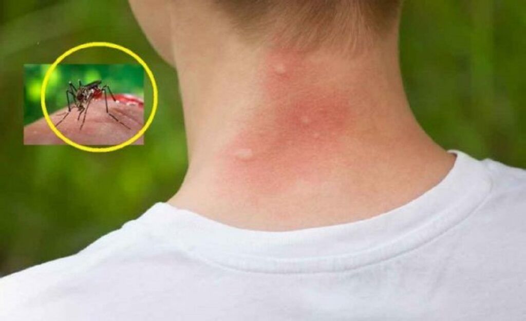 Țânțarii te mușcă mai des? Trei bacterii cheia misterului